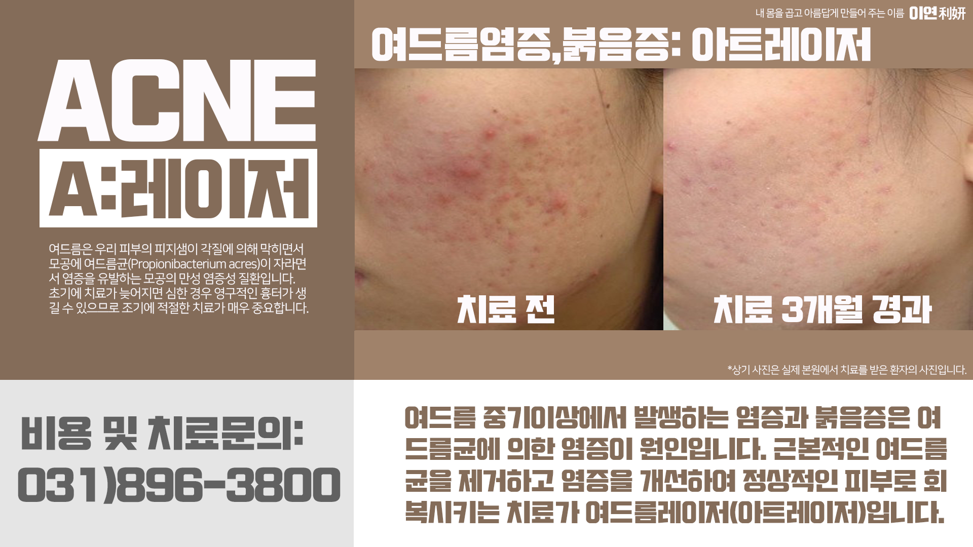 여드름 치료 이미지