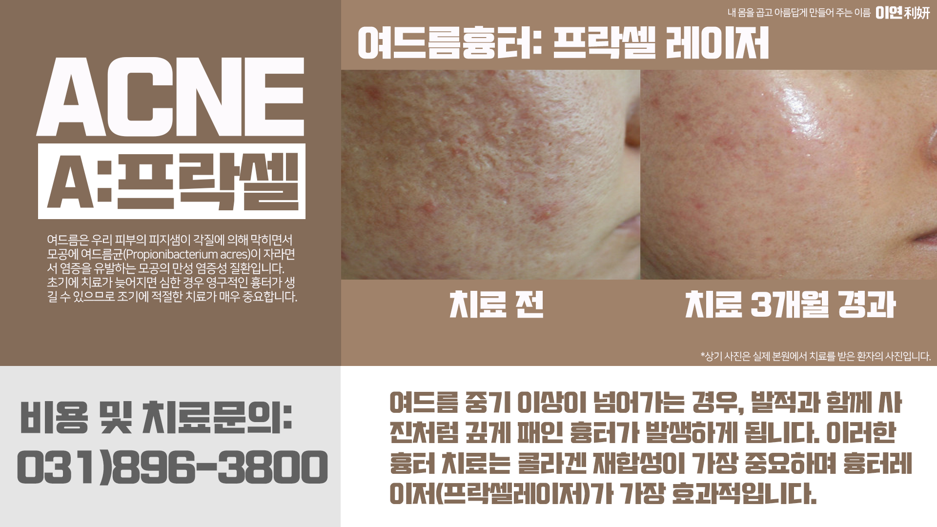 여드름 흉터 레이저 시술 이미지